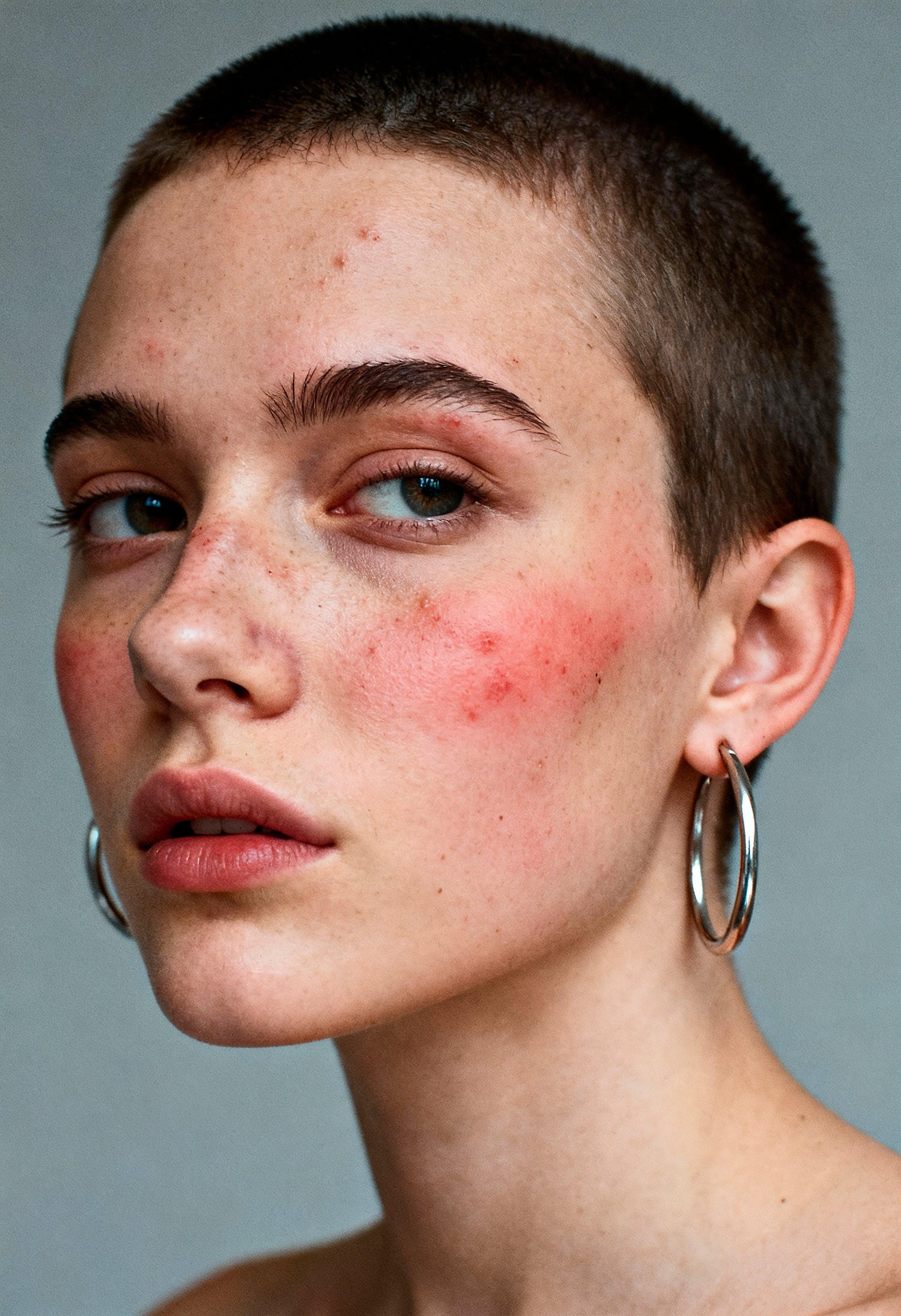 Piel con rosácea - Namü 나무